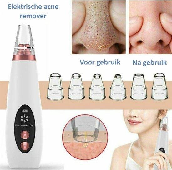 BlackHead Remover before/after