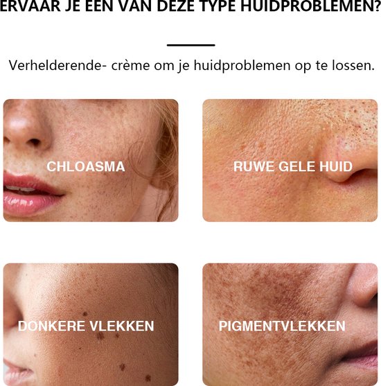 Pigment Creme helpt tegen chloasma, gele en donkere vlekken en pigmentvlekken 